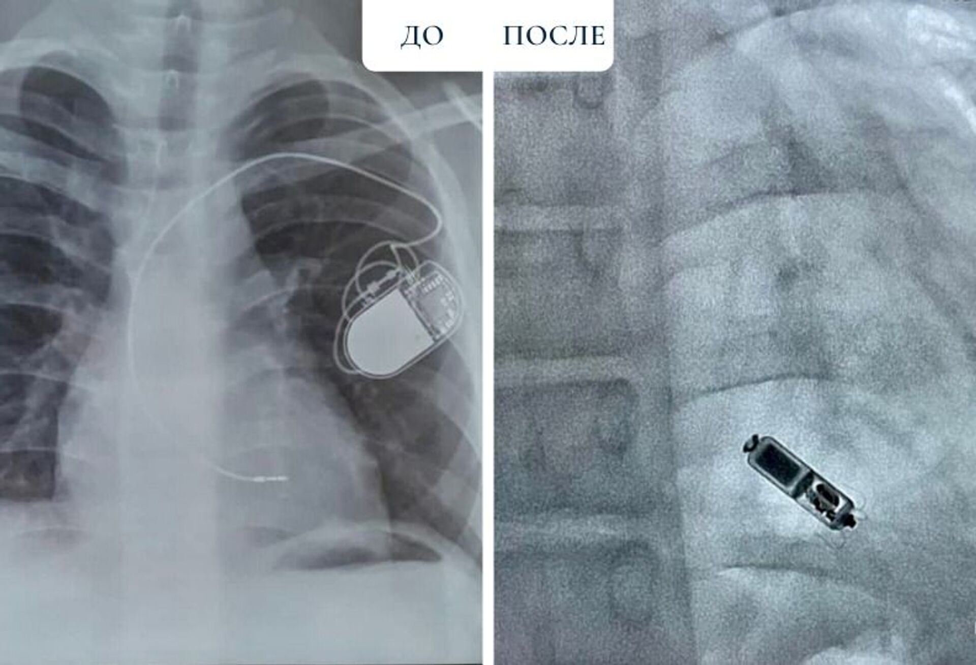 Имплантация самого маленького кардиостимулятора в мире успешно прошла в Нур-Султане - Sputnik Казахстан, 1920, 17.08.2021
