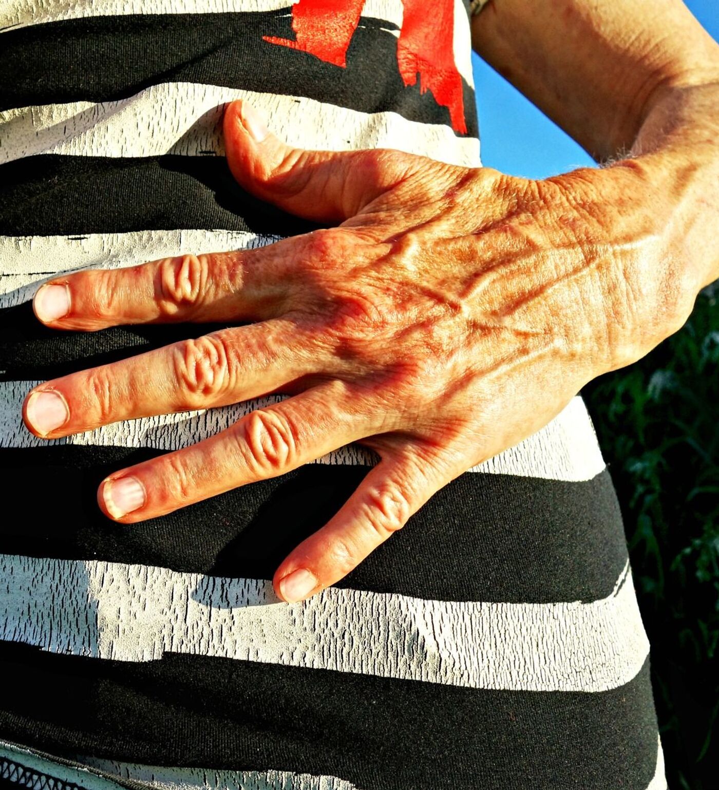 Пенисадағы варикозды тамырлар Пенисадағы варикозды тамырлар