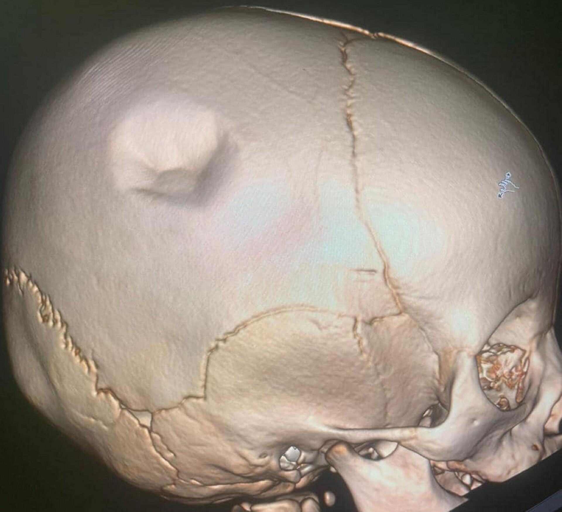 В стенах Мангистауской областной детской больницы провели трепанацию черепа шестимесячному ребенку - Sputnik Қазақстан, 1920, 22.04.2022