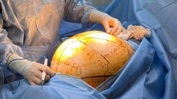 25-килограммовую опухоль удалили у пациентки в Алматы - Sputnik Казахстан