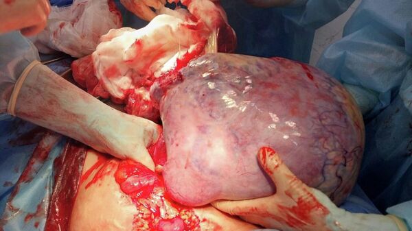 У казахстанки удалили опухоль весом более 6 кг - Sputnik Қазақстан
