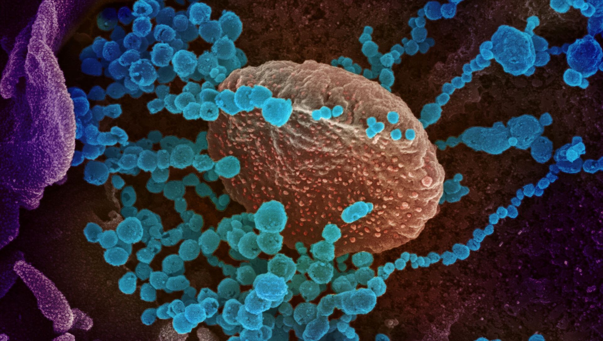 Вид на зараженную коронавирусом  клетку под микроскопом  - Sputnik Қазақстан, 1920, 29.11.2021