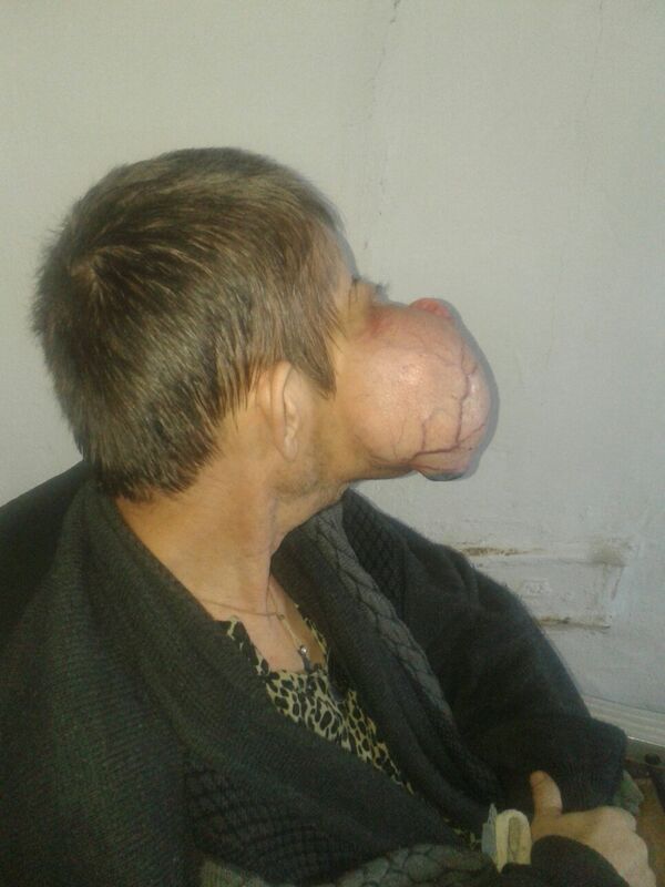 Мужчина с опухолью на лице Мужчина с опухолью на лице - Sputnik Казахстан