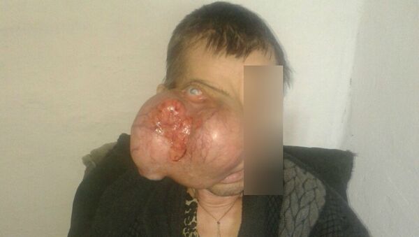 Мужчина с опухолью на лице - Sputnik Казахстан